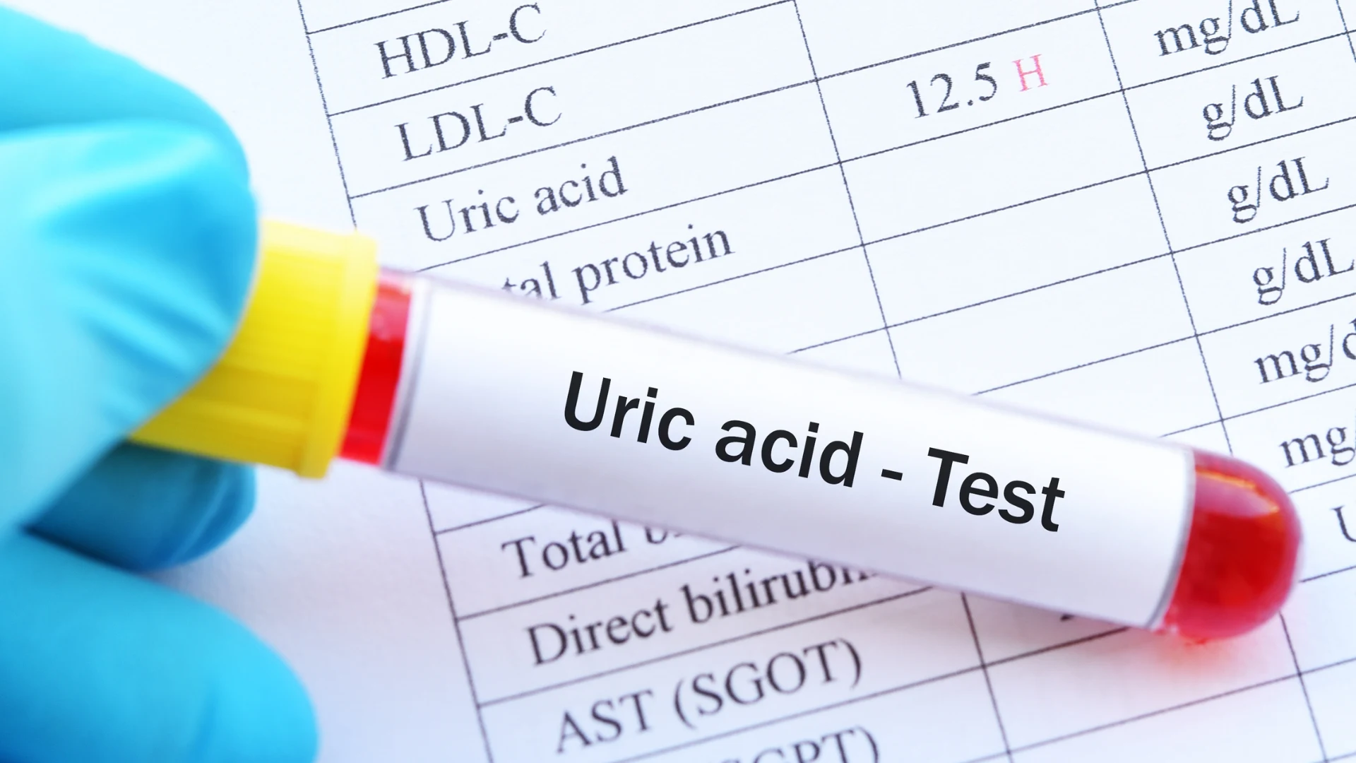 Uric Acid Test